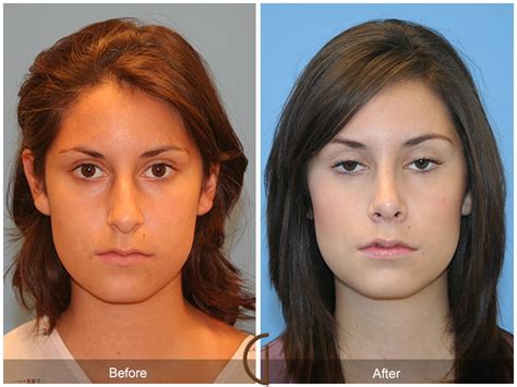 Rhinoplasty recovery Facts & Expectations - HealthPulls