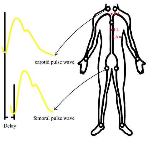 PULSE WAVE ANALYSIS (PWA) INFO – PulseWave Velocity