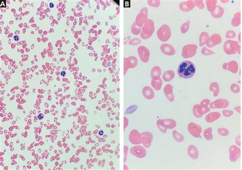 Megaloblastic Anemia Peripheral Smear