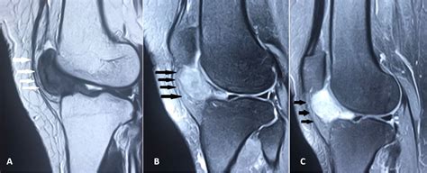 Cureus | Unusual Occurrence of Tenosynovial Giant Cell Tumor in Hoffa's Fat Pad: A Potential ...