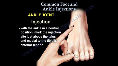 Common Foot And Ankle Injections - Everything You Need To Know - Dr. Nabil Ebraheim - YouTube