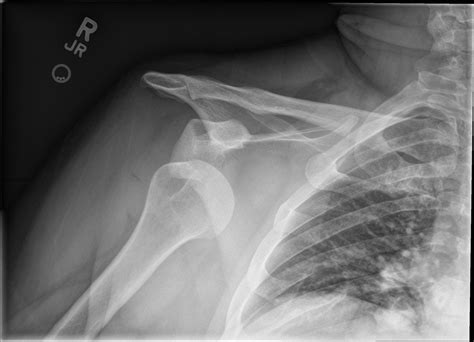 Shoulder Dislocation – Core EM