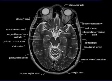 MRI anatomy | Free MRI Axial Brain Anatomy