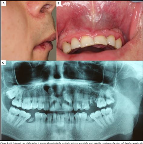 Figure 7 from Maxillary dentigerous cyst and supernumerary tooth. Is it ...