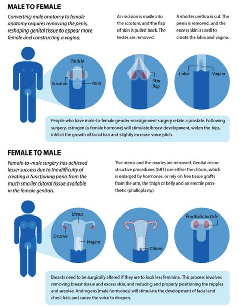 The Procedure of SRS - Sexual Identity and Sex Reassignment Surgery