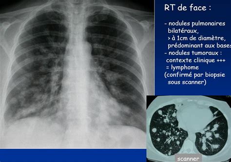 diff¨¦rence entre le scanner et radiographie pulmonaire | heju – blog deco, diy, lifestyle