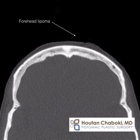 Lipoma Ultrasound Treatment - Infoupdate.org