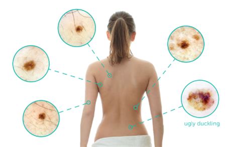 Melanoma Skin Cancer | Mole Check and Removal | SunskinCancer