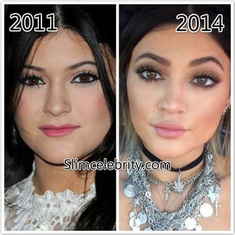 Kylie Jenner Nose Job | Celebrity Nose Jobs | Kylie jenner plastic ...