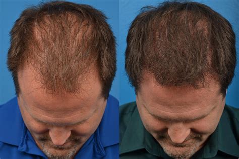 Hair Restoration Photos | Melbourne, FL | Patient 57533