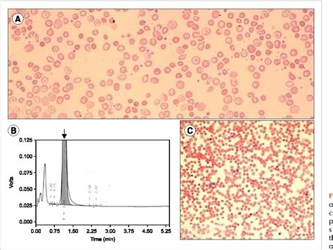 [PDF] Delta beta thalassemia: a rare hemoglobin variant | Semantic Scholar