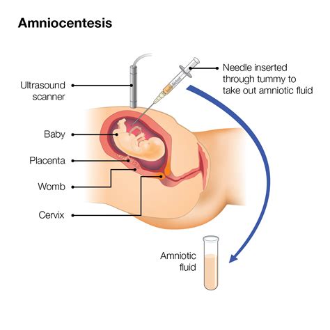 Amniocentesis Diagnostic Procedure Template