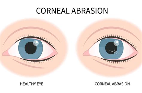 What Is Corneal Abrasion and How Can It Be Treated?