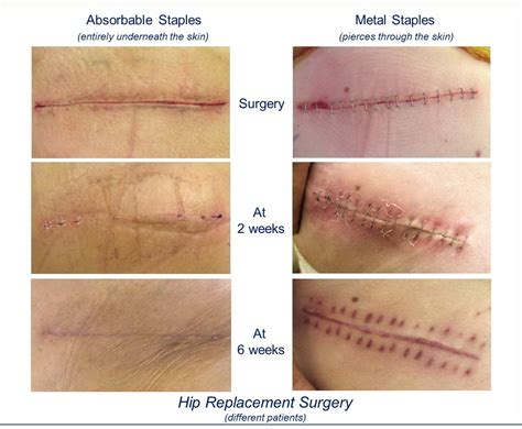 Incisive Surgical Announces Sale of Two Millionth INSORB Stapler