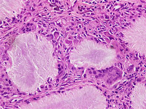 Tophus Histology