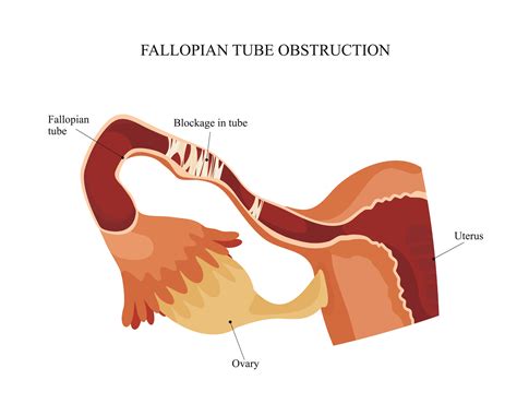 Blocked Fallopian Tube: Symptoms, Causes and Treatment