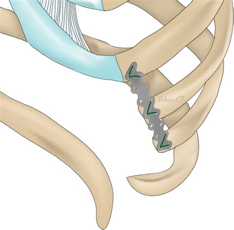 An illustration of the surgical approach for the treatment of recurrent ...