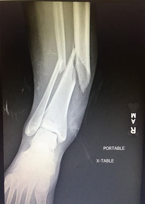 My recent tibia and fibula fracture : r/medizzy