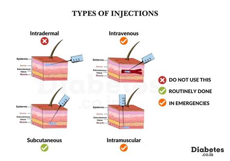 Are Insulin Injections Subcutaneous or Intramuscular?