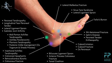 Foot Pain On Outside Of Foot When Walking Deals | emergencydentistry.com