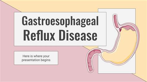 Gastroesophageal Reflux Disease | Google Slides & PPT