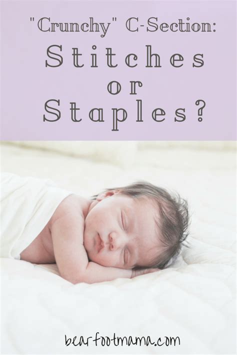 Getting ready for your Cesarean Section? Wondering whether stitches or ...