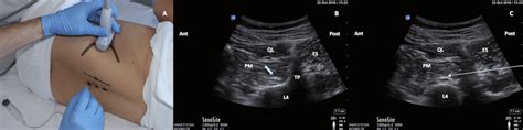 -a) the patient (model photo) is placed lateral decubitus with the side... | Download Scientific ...