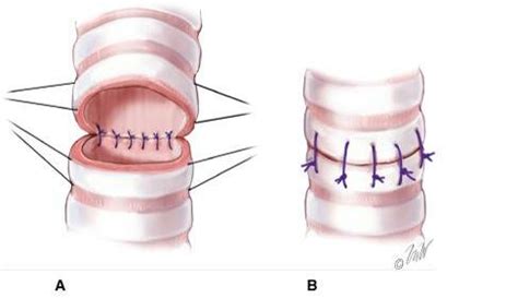 End to end anastomosis | Download Scientific Diagram