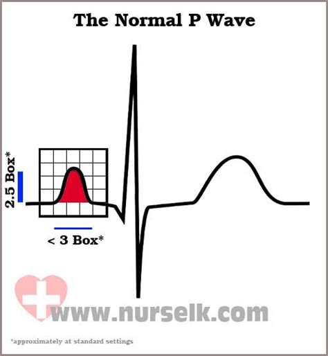 How to read an Electrocardiogram (ECG) - Part 3, The P Wave | Nurselk.com