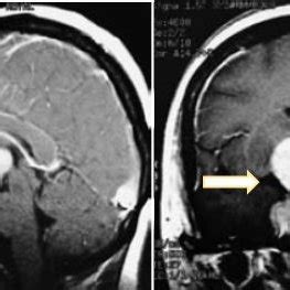 Pituitary macroadenoma on MRI examination (arrow). | Download Scientific Diagram