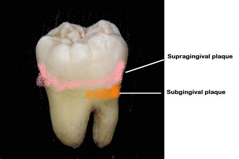 What is Plaque ? | Dental Clinics, Dentists, Klinik Gigi & 牙医 in Malaysia