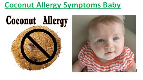 Coconut Allergy Symptoms Baby - Fruits Facts