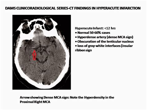 Dense MCA sign-Hyperacute Infarction - Sumer's Radiology Blog