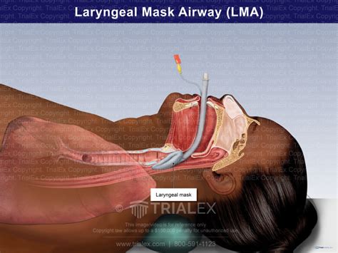 Laryngeal Mask Airway (LMA) - TrialQuest Inc.