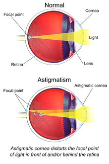 Astigmatism - Wikipedia