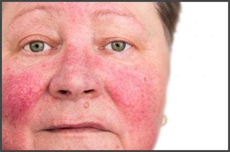 Psoriasis on face pictures | Psoriasis expert