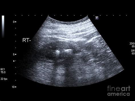 Kidney Stones, Ultrasound Scan Photograph by Science Photo Library - Fine Art America