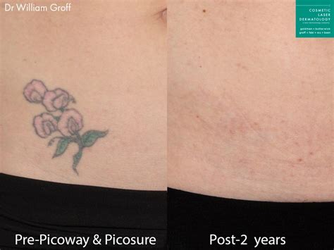 Picosure Laser Skin Treatment | San Diego, CA | CLDerm