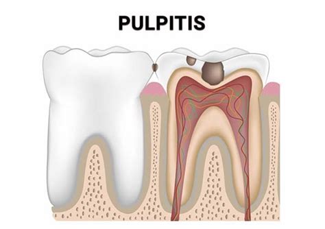 Tooth Infection Dentist in Stamford | Qualified Infected Teeth Treatment