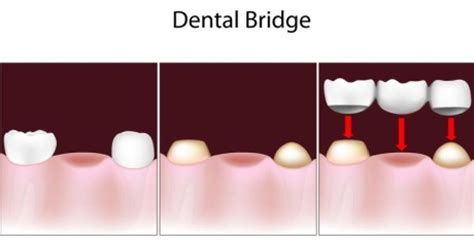 Dental Bridges: Why It's Done, Risks, What to Expect