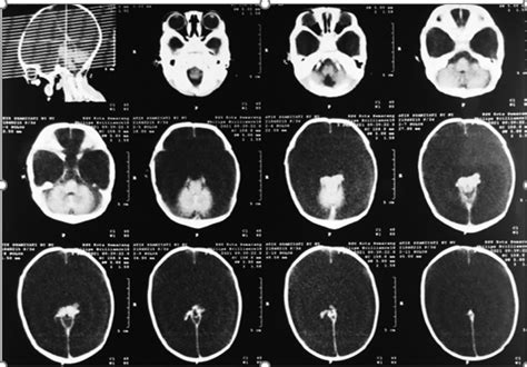 Case Report: Hydranencephaly in a female newborn... | F1000Research