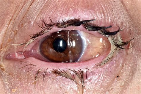 Conjunctivitis - HSE.ie