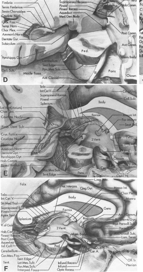 Figure 2 from Microsurgical anatomy of the region of the tentorial incisura. | Semantic Scholar