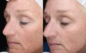 Jan Marini Skin Care | Before & After | LightRx MedSpa