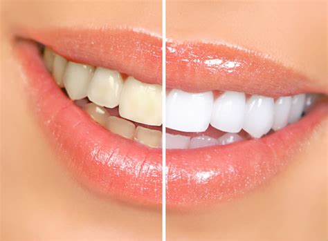 Teeth Whitening | Aqua Dental Clinic (London)