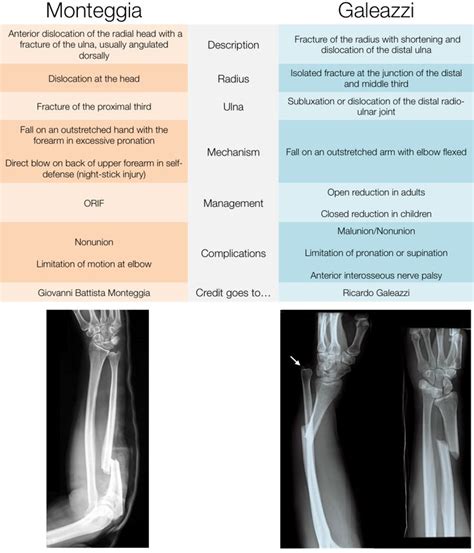 Galeazzi vs Monteggia fx | Orthopedics, Musculoskeletal, Rheumatology | Pinterest