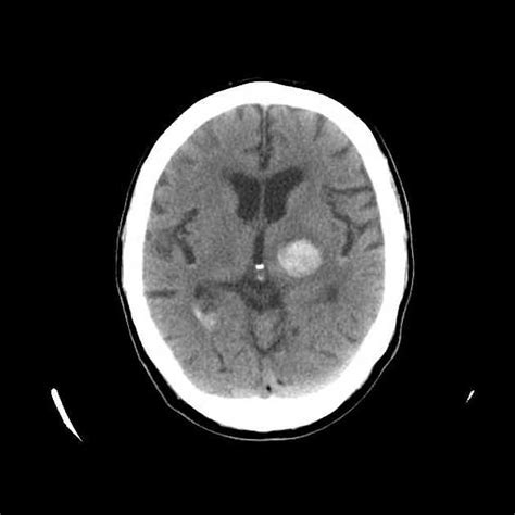 Hemorrhagic stroke CT - wikidoc