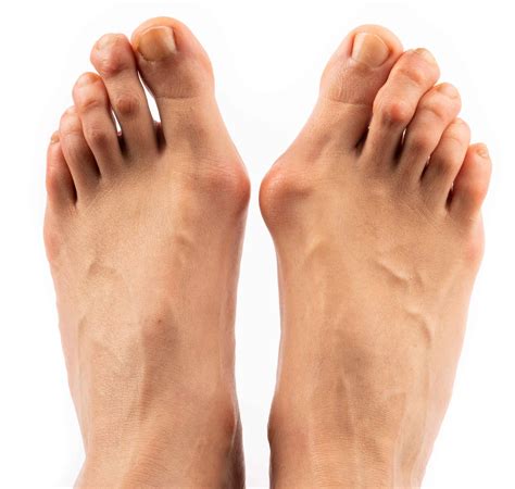 Hallux valgus: 10 Fakten | Natürlich behandeln | Ursache & Schmerzen