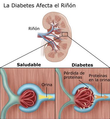 AsisMed: ¿Conoces lo que es la Nefropatia Diabetica?