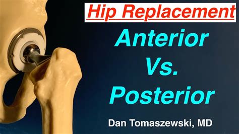 Anterior Vs Posterior Hip Replacement - YouTube